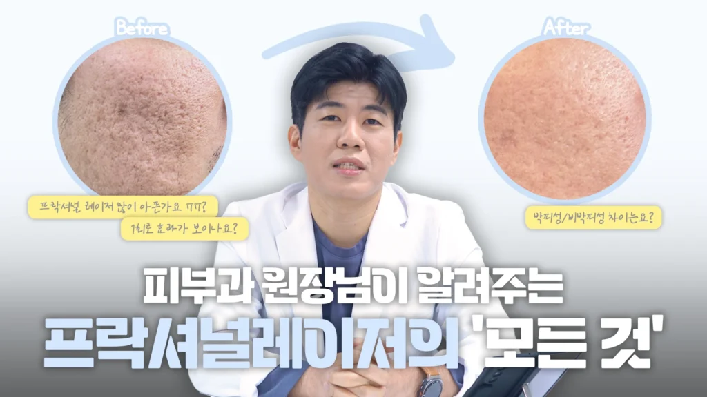 여드름 흉터,모공으로 고통받은 30대 남자, 프락셔널 레이저로 피부재생 시킨다?!
